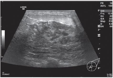 Bilateral Idiopathic Granulomatous Mastitis A Case Report