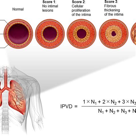 Description Of The Index Of Pulmonary Vascular Disease IPVD All