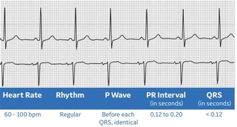 Medical Physiology Ekgs Flashcards Quizlet