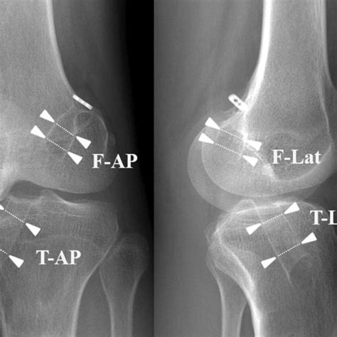 Postoperative Anteroposterior Ap And Lateral Radiographs Showing Download Scientific Diagram