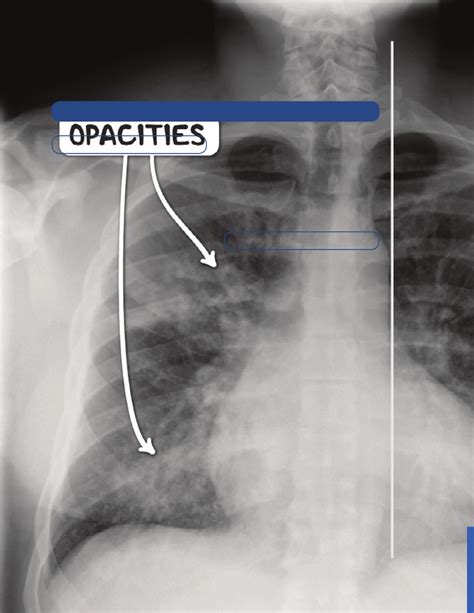 Lower respiratory tract infection Notes: Diagrams & Illustrations | Osmosis