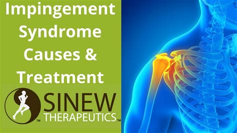 Impingement Syndrome Causes And Treatment Youtube