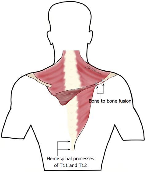 Anatomy Of Scapular Winging