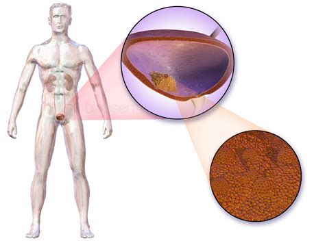 What Is Bladder Cancer Bladder Cancer Causes Symptoms Treatment Stages Facts