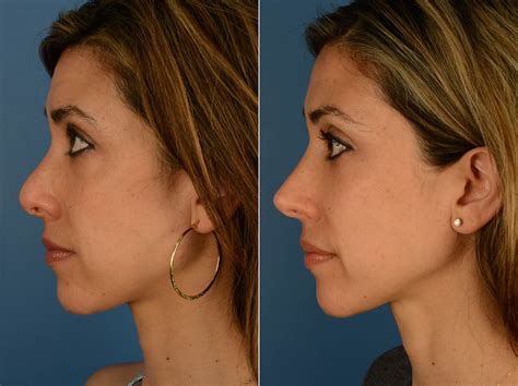 Before And After Plastic Surgery Results Top Surgeons Mexico