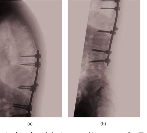 Figure From Salmonella Typhi Vertebral Osteomyelitis And Epidural