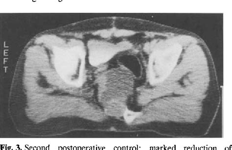 The Management Of Anterior Sacral Meningocele With Computed Tomography