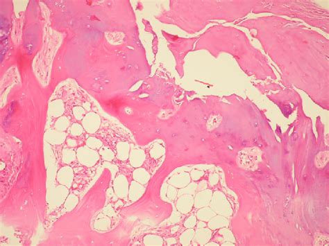 Microscopic View Of The Removed Bone Fragment With Lamellar Bone