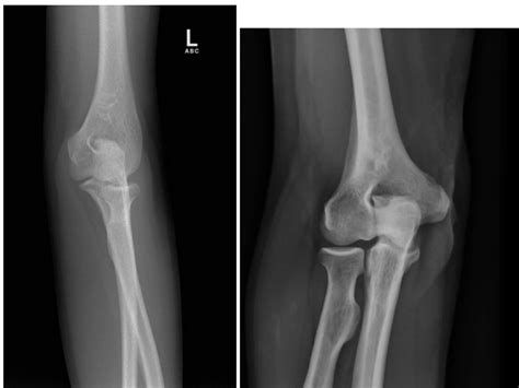 Medial And Lateral Oblique Elbow Diagram Quizlet