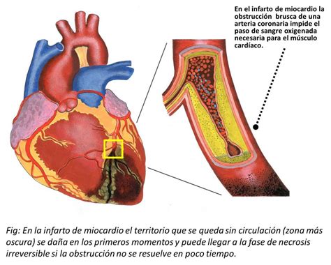 ¿qué Es El Infarto Agudo De Miocardio