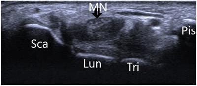 Frontiers B Mode Ultrasound Imaging In Diagnosing Carpal Tunnel