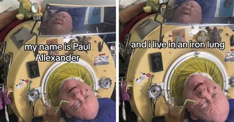 Remembering Paul Alexander One Of The Last Polio Survivors Who Lived