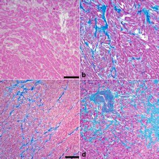 Histology of cardiac myocyte hypertrophy. Note the increased cardiac ...