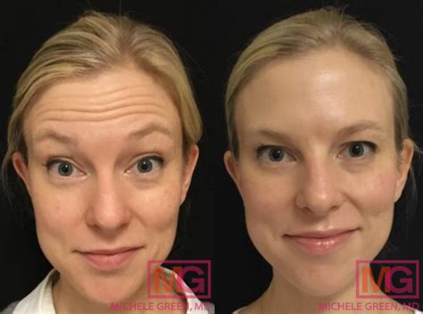 Botox Before And After Forehead Lines