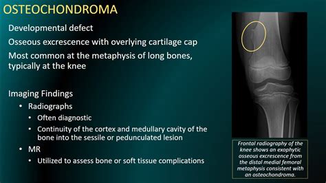 Osteochondroma Radiology