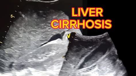 Liver Cirrhosis Ultrasound Youtube