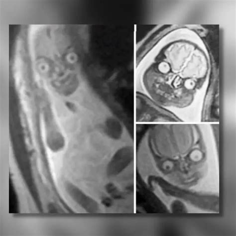 Fetal MRI : r/oddlyterrifying