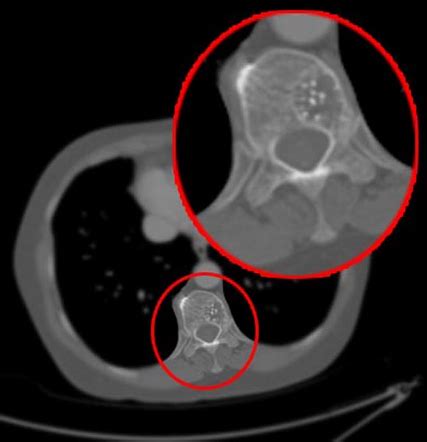 Intraosseous Hemangioma Vertebral Radiology Case Radiopaedia Org