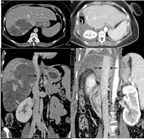 Figure 1 From Bilateral Lower Limb Edema Caused By Compression Of The