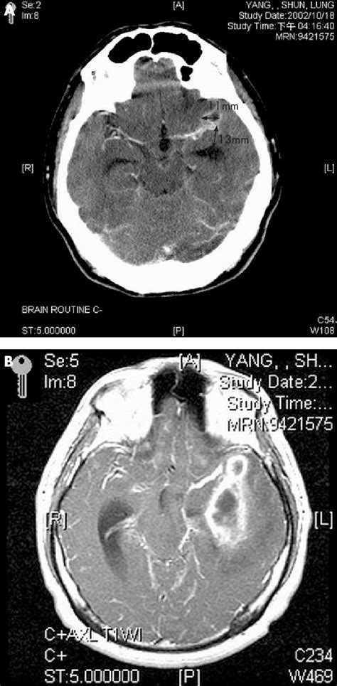 A 34 Year Old Man Presented With Postneurosurgical Central Nervous