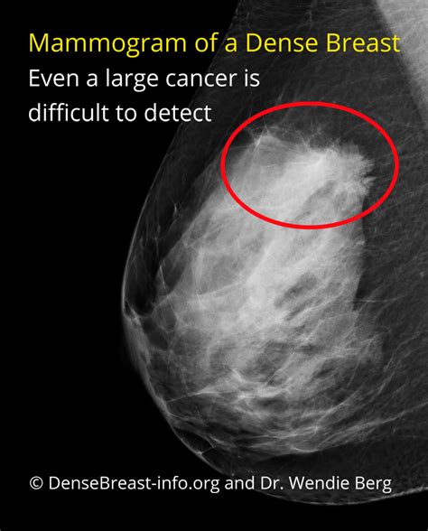 Mammogram vs. Thermogram vs. Other – Thermography Advantage