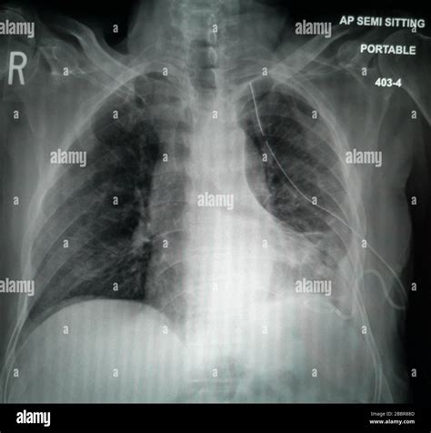 Radiografia Toracica Immagini E Fotografie Stock Ad Alta Risoluzione