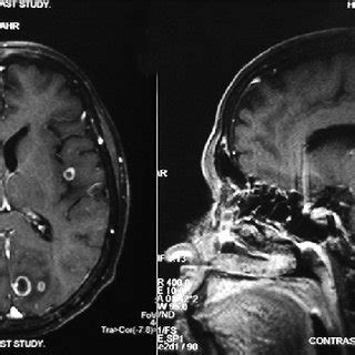 Contrast Enhanced Magnetic Resonance Imaging Scan Showing Lesion In