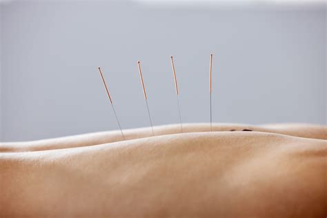 Is pain needling at you? Dry needling explained! | Heale's Clinics