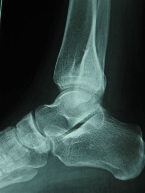 Osteochondroma Of The Distal Fibula Causing Disruption Of The