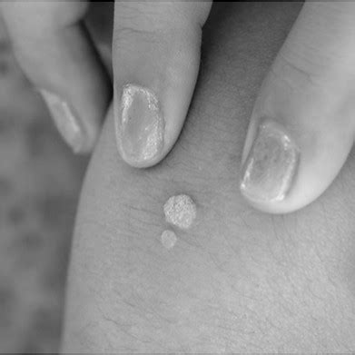 Common Warts - Our Pipeline | Veradermics | Revolutionizing Dermatology ...