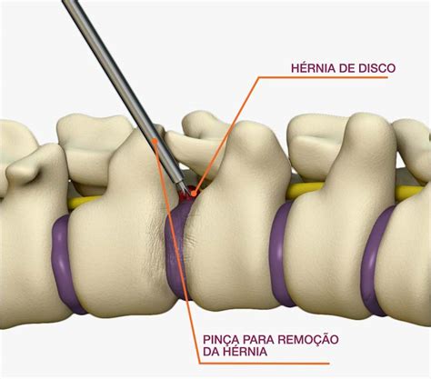 Endoscopia De Coluna Em Porto Alegre Especialista Em Coluna