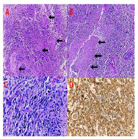 Gliomas De Alto Grado En Pacientes Pediátricos Post Radioterapia