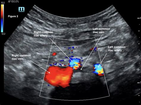 May Thurner Transverse Ultrasound Of The Abdomen With Color Flow