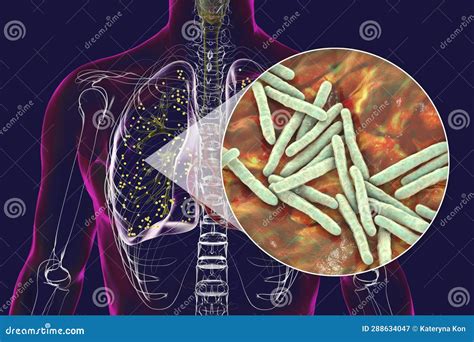 Human Lungs Affected By Miliary Tuberculosis With A Close Up View Of