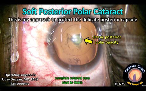 1675: soft posterior polar cataract – Cataract Coach™