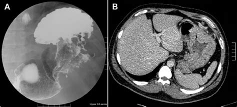 A Barium Fluoroscopic Upper Gastrointestinal Series And B Upper