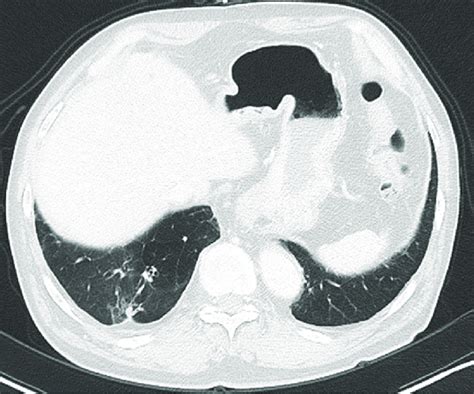 A Ct Scan After 6 Months Of Erlotinib Treatment Showed That The Nodule