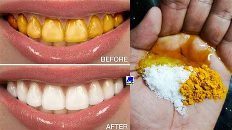 How To Whiten Your Yellow Teeth Naturally At Home In Just 23 Minutes 100 Effective Youtube