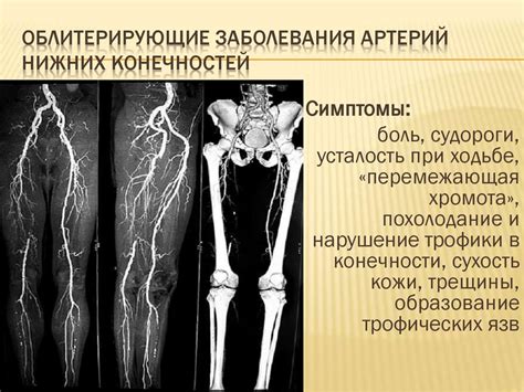 Эндоваскулярные технологии в лечении облитерирующих заболеваний артерий ...