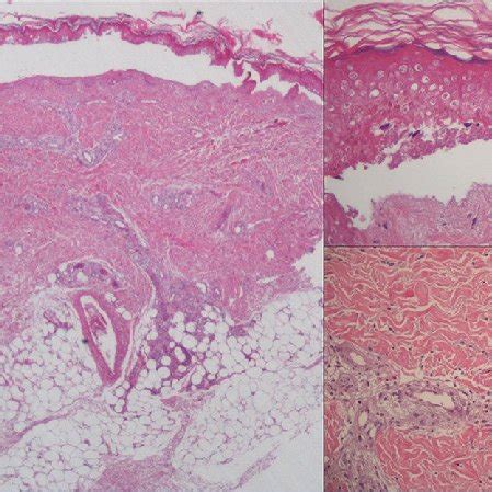 (A) Histologic exam: necrotizing vasculitis with occlusive vasculopathy ...