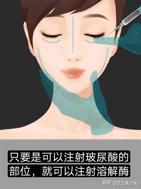 微整还有后悔药？你知道玻尿酸溶解酶吗？ 知乎