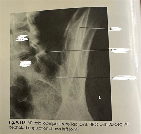 Ap Axial Oblique Sacroiliac Joint Rpo Diagram Quizlet