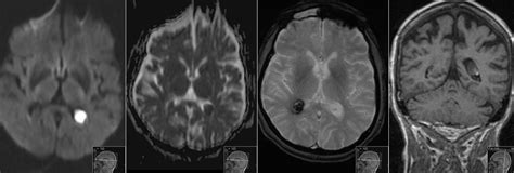 Hemorrhagic Choroid Plexus Cyst