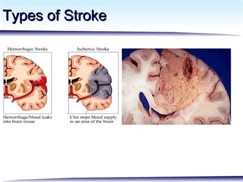 Neuroprotection In Stroke