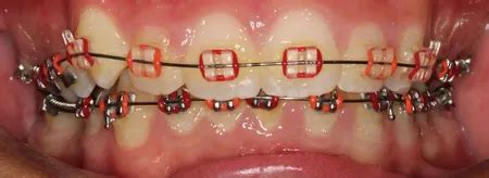 Braces Colours - Show off your personality with colour!