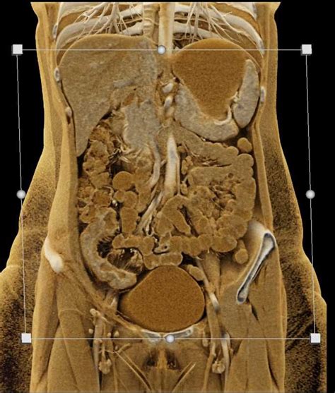 Crohn's Disease Involving the Terminal Ileum with Prominent Enhancement ...