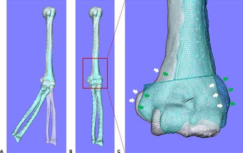 Dimensional Prebent Plate Fixation In Corrective Osteotomy Of