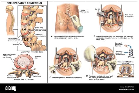 Low Back Pain Recurrent L Disc Herniation With Laminectomy Stock