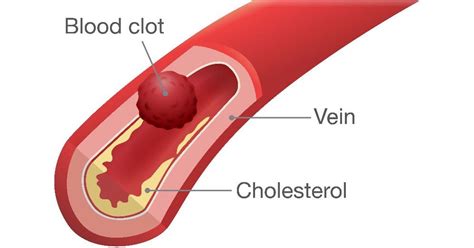 Treatments of Blood Clots - Facty Health