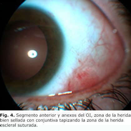 Trauma ocular a globo abierto asociado a cuerpo extraño intraocular